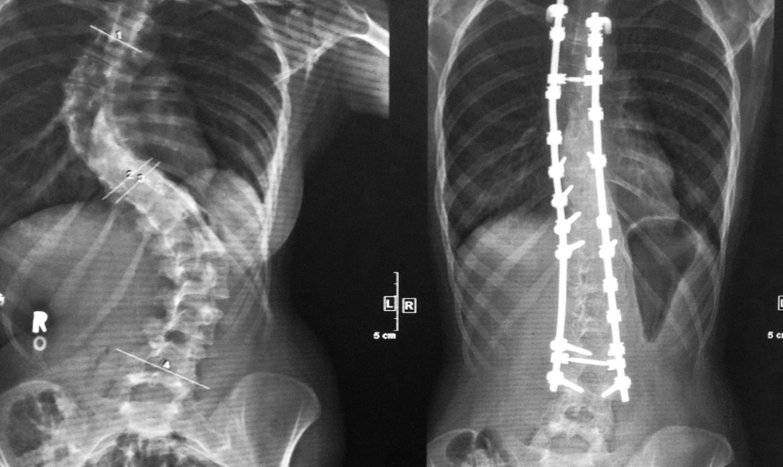 X-Ray of spine before and after treatment for scoliosis