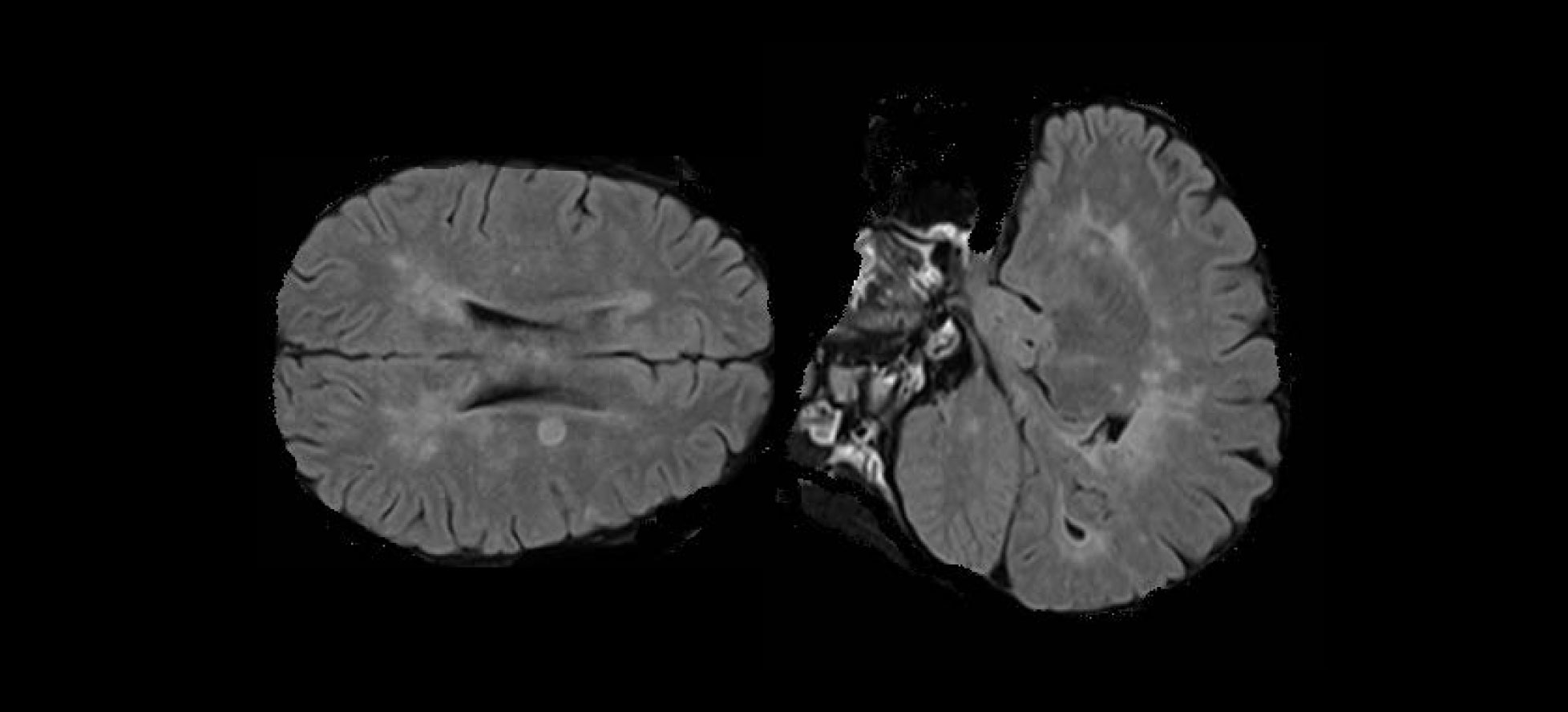 Brain Scan X-ray Results